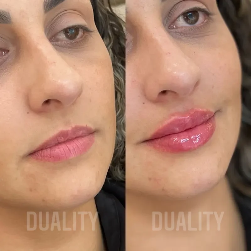 Antes e depois de preenchimento labial com ácido hialurônico
